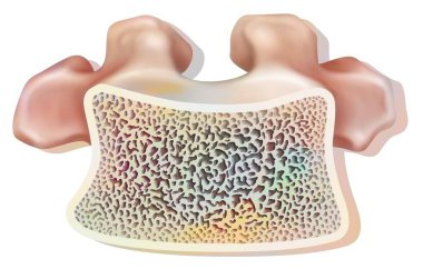 Structure of a healthy dorsal vertebra with spongy and compact tissue.