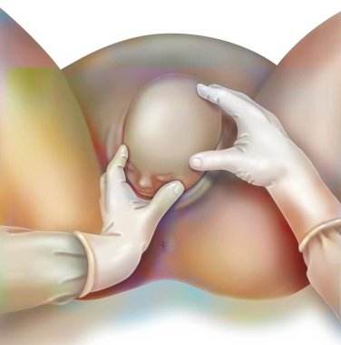 Childbirth, stage 2: the baby's head is out.
