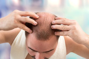 Baldness. close-up of bald man