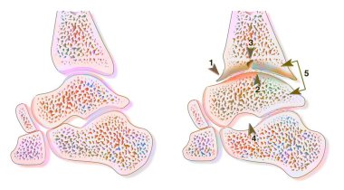 Comparison between a healthy ankle and hemophilic arthropathy (hemarthrosis).