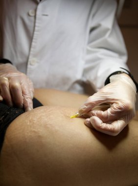 Treatment of cellulite and stretch marks by carboxytherapy, or the subcutaneous injection of carbon dioxide.