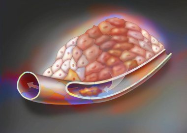 Cancerous tumor, stage 3: Cancer cells have multiplied and transformed.