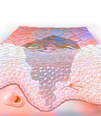 Skin, keratosis: thickening of the horny layer of the epidermis.