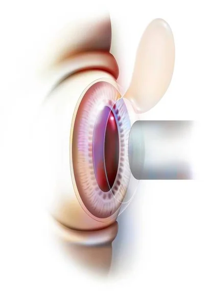 Eye Laser Operation Here Lasik Correct Refractive Errors — Fotografia de Stock