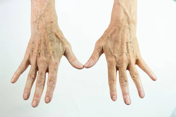 Ένα Χέρι Κηλίδες Γήρατος Και Άλλο Λέιζερ — Φωτογραφία Αρχείου