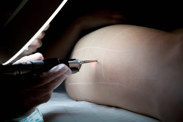 Laser Hair Removal Session Beauty Salon — Fotografia de Stock