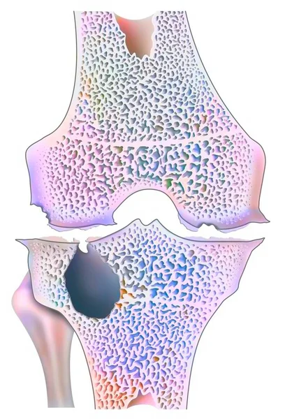 Knee Hemophilic Arthropathy Marginal Joint Erosion — Zdjęcie stockowe