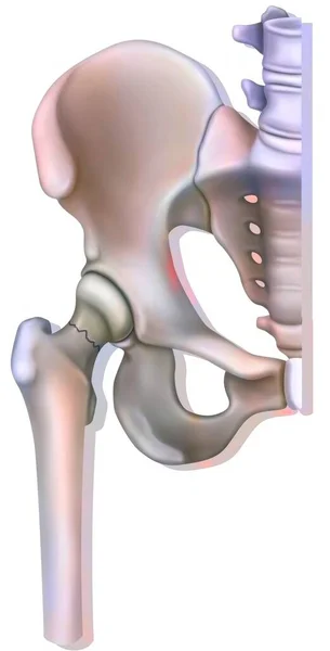 Bone System Fracture Neck Femur Linked Osteoporosis — Zdjęcie stockowe