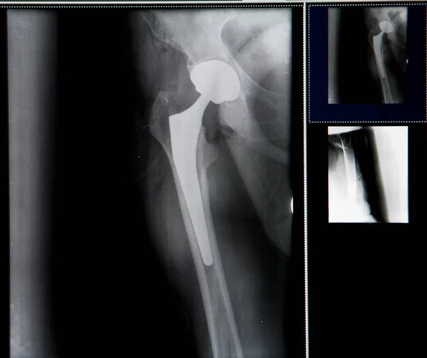 X-ray of the patient\'s hip after placement of the prosthesis.