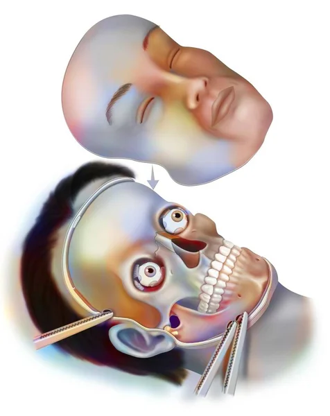 Transplant New Face Facial Skeleton Patient — Stock Photo, Image