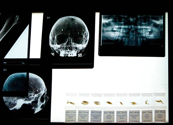 Forensic science and criminal research: x-ray of a skull having been shot several times.