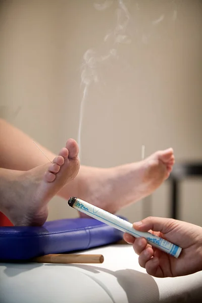 Therapist Specializing Traditional Chinese Medicine Practicing Acupuncture Moxibustion — Stock Photo, Image