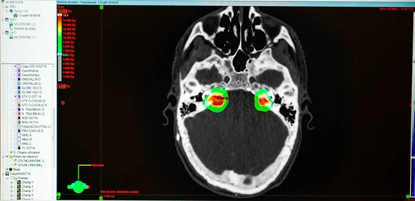 Treatment Neuroma Which Treated Radiosurgery —  Fotos de Stock