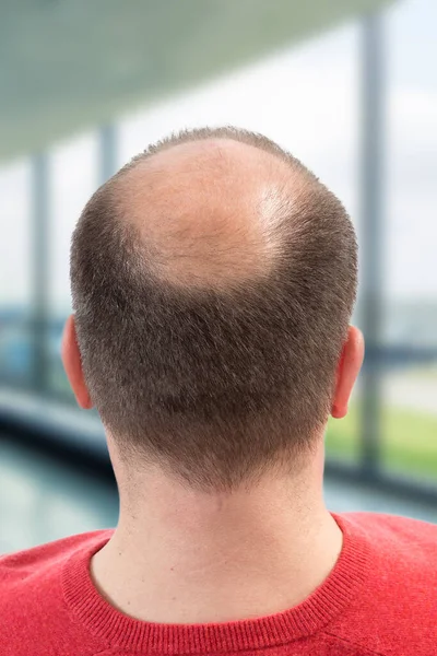 Baldness Close Bald Man — Stockfoto