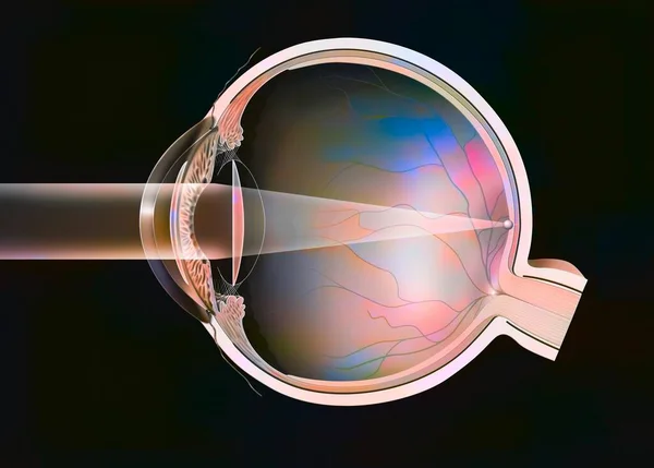 Eye Cataract Intraocular Implants Anterior Posterior Chamber — Zdjęcie stockowe