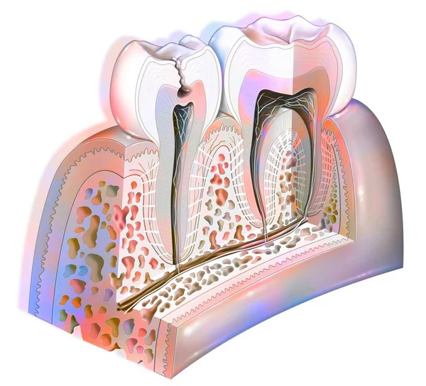 Dental Plaque First Stage Tooth Decay — Stock Photo, Image