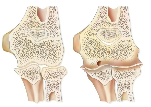 Comparison Healthy Elbow Hemophilic Arthropathy Hemarthrosis — Stock Photo, Image