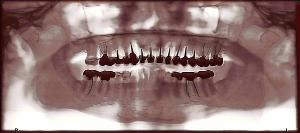 Dental Panoramic Year Old Person Multiple Crowns — Stockfoto