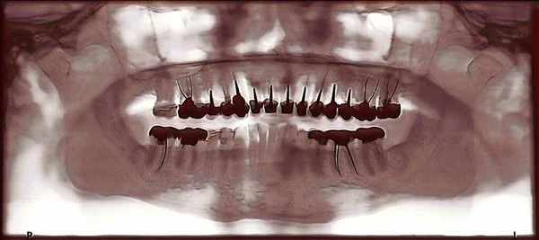 Dental Panoramic Year Old Person Multiple Crowns — 스톡 사진