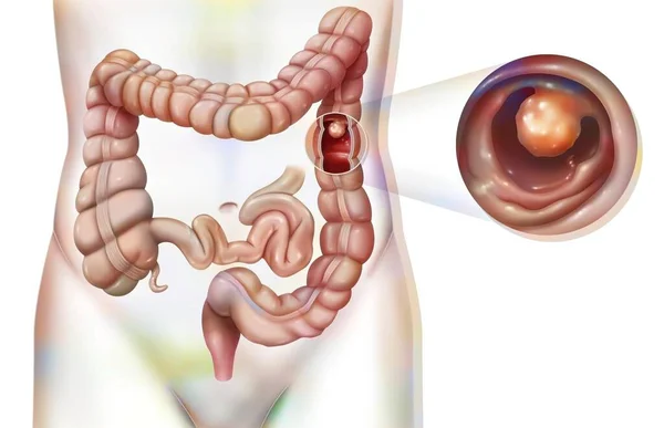 Digestive System Colon Colonic Polyp — Fotografia de Stock