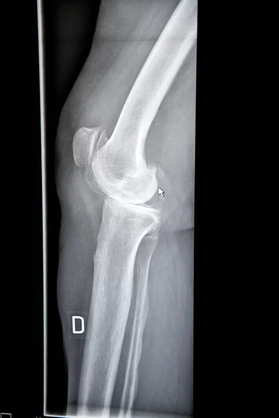 Ray Knee Patient Onset Osteoarthritis — Stock Photo, Image