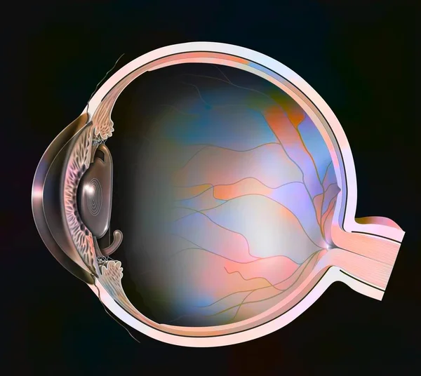Eye Presbyopia Multifocal Implant Inserted Replace Lens — Foto Stock