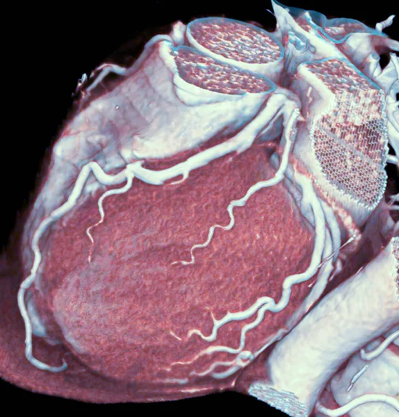 Scan Normal Coronary Arteries — Zdjęcie stockowe