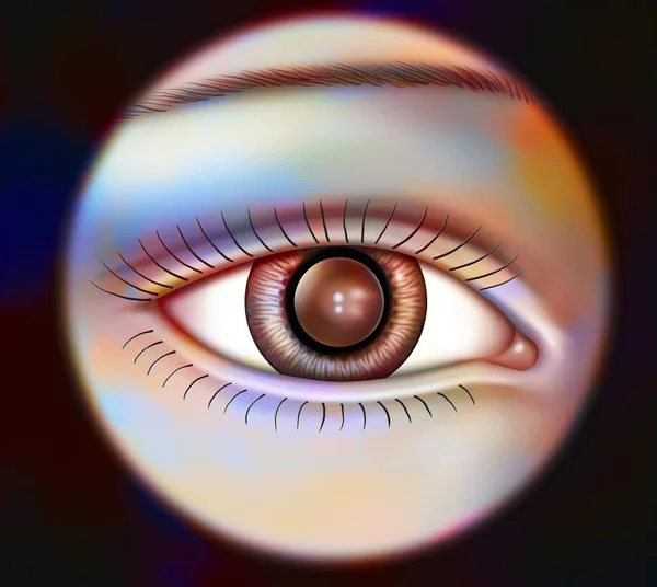 Eye Implant Permanently Placed Anterior Chamber — Zdjęcie stockowe