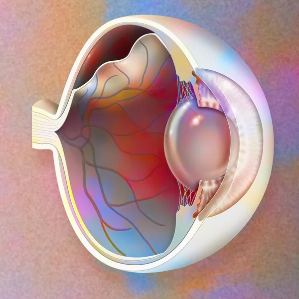 Eye Detachment Retina Which Detaches Underlying Choroid — Stock Photo, Image