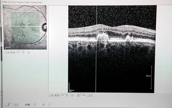 Optical Coherence Tomography Oct Showing Beginnings Macular Degeneration — Photo