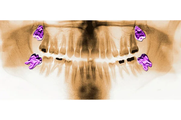 Purple Wisdom Teeth — Photo