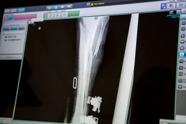 Ray Leg Patient Who Had Ski Fall Fractured Tibia Fibula — Photo
