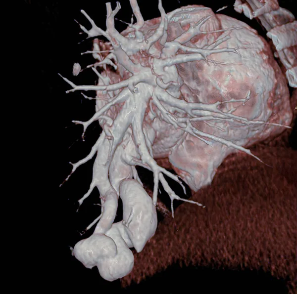 Pulmonary Arteriovenous Fistula Congenital Anomaly Consisting Direct Communication Pulmonary Arterial lizenzfreie Stockfotos