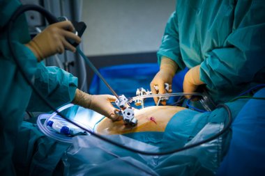 Hysterectomy in the operating room with a robot surgeon, installation of the four arms of the robot including a camera.