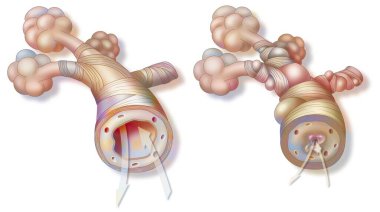 Asthma: healthy bronchiole (left) and asthmatic (right). clipart