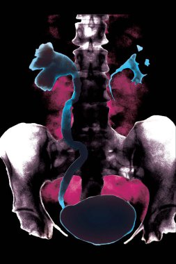 RENAL LITHIASIS, X-RAY