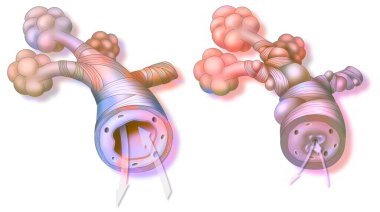 Asthma: healthy bronchiole (left) and asthmatic (right). clipart