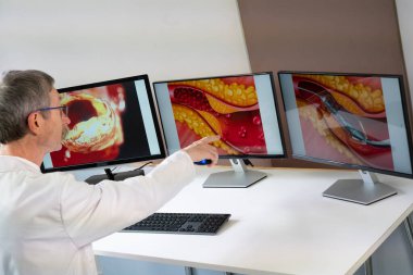 A doctor showing atheroma plaque and stent placement images on computer screens.