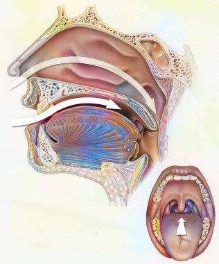 Airways (nasopharynx) in snorers: decrease in muscle tone.