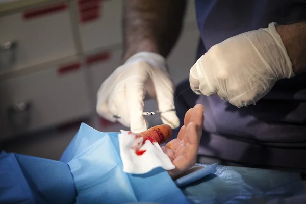 The mountain doctor stitches a patient with an open dislocation of the thumb from a ski fall.