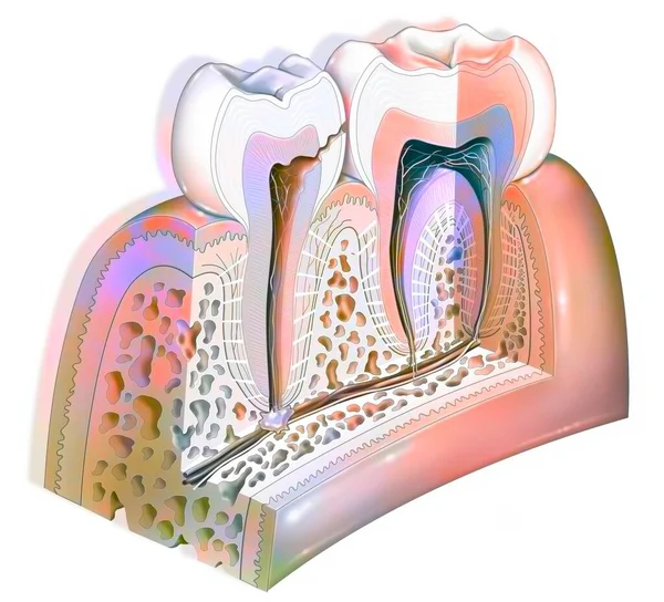 Dental Plaque Third Stage Tooth Decay Damage Dental Pulp — Fotografia de Stock