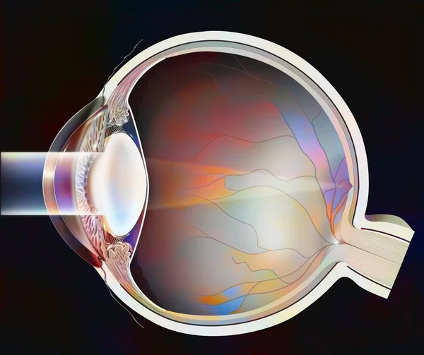 Eye Sagittal Section Lens Severe Cataract — Stock Fotó
