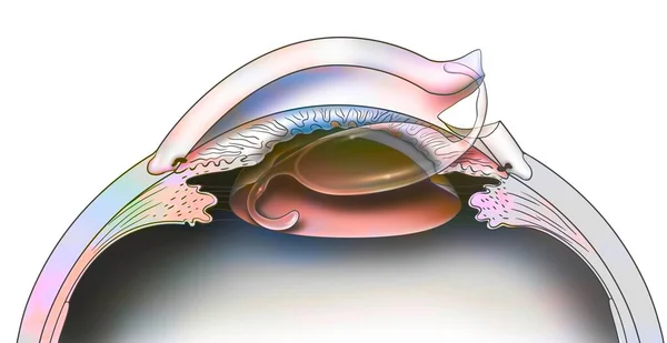 Глаз Размещение Внутриглазного Имплантата Лечения Катаракты — стоковое фото