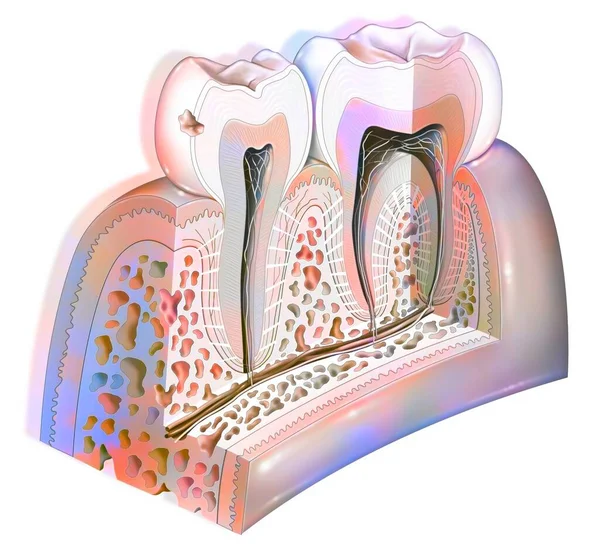 Dental Plaque First Stage Tooth Decay — Stock fotografie