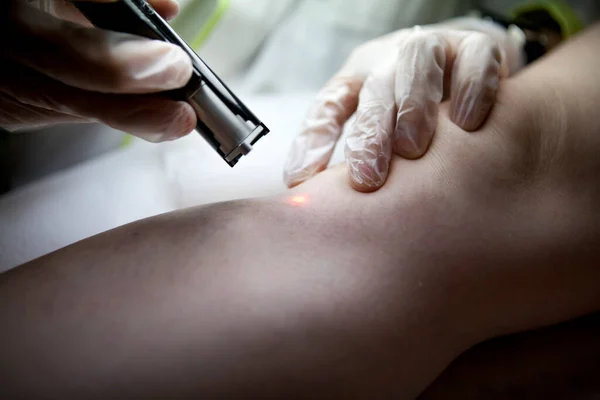 Laser removal of spider veins from the legs in a beauty salon. .