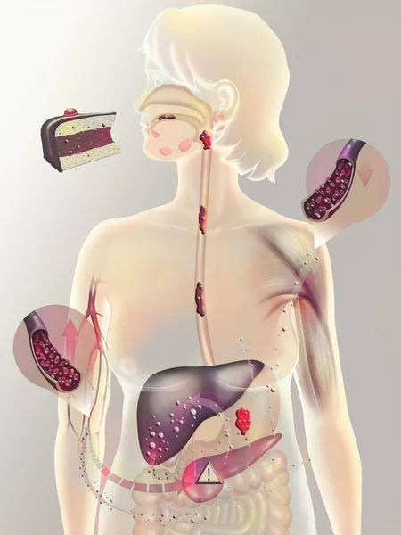 Secretion Insulin Person Diabetes Type Diabetes Type Non Insulin Dependent — ストック写真