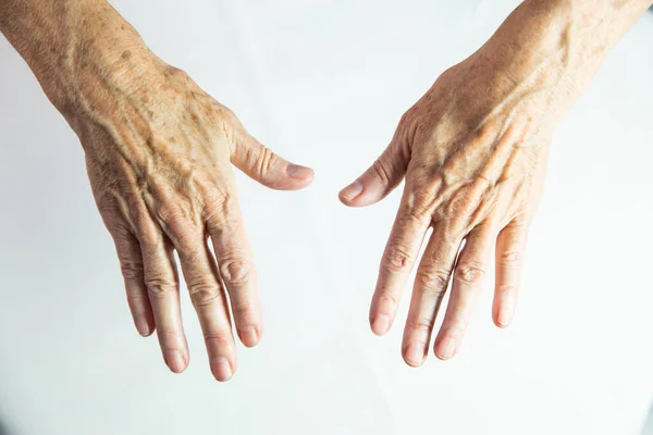 Hands Spots Old Age —  Fotos de Stock