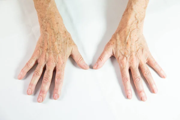 Hands Spots Old Age — Stockfoto