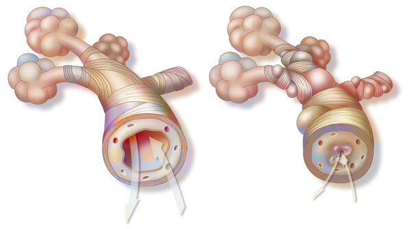 Астма: здоровая бронхиола (слева) и астматическая (справа)).
