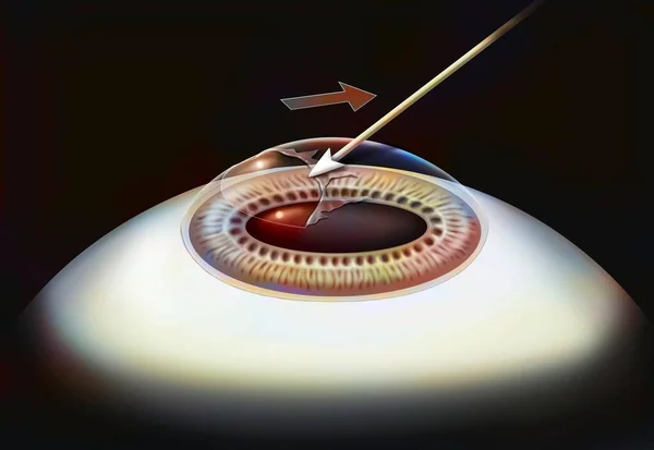 Eye Surgery Photokeractectomy Step Corneal Epithelium Layer Detached — ストック写真